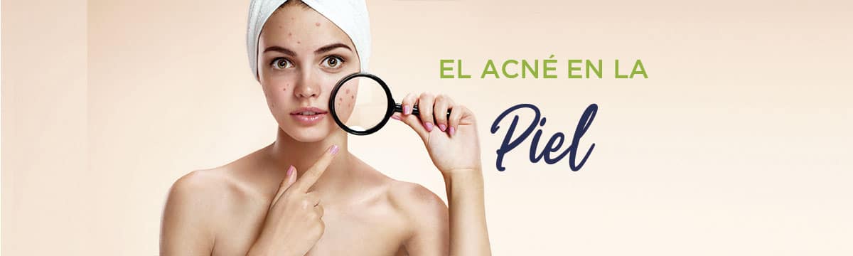 El acné en la piel